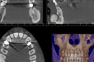 sinuzita cronica sau doar raceala cum te ajuta ct ul de sinusuri 692effd3275ff