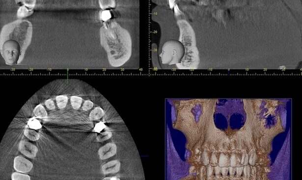 sinuzita cronica sau doar raceala cum te ajuta ct ul de sinusuri 692effd3275ff