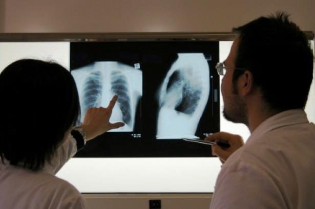 insp romania continua sa inregistreze cea mai ridicata rata a incidentei tuberculozei din ue tristele date ale zilei mondiale a tuberculozei 69c24d51de60b